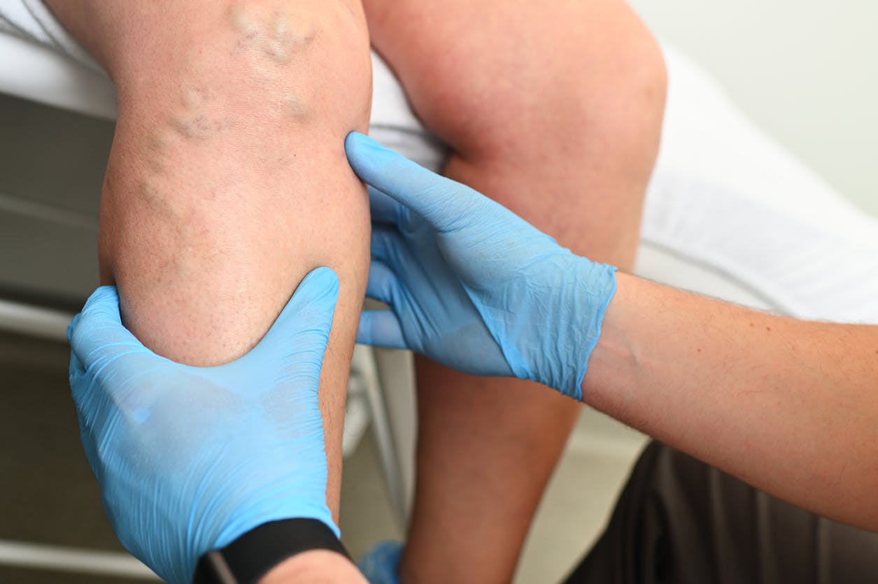 doctor examining a patient's varicose veins stock photo