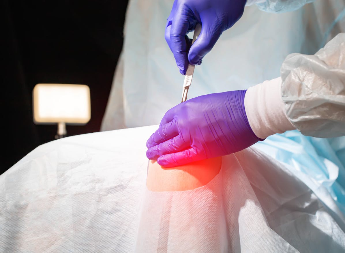 Gloved hands with a scalpel begin a knee replacement surgery
