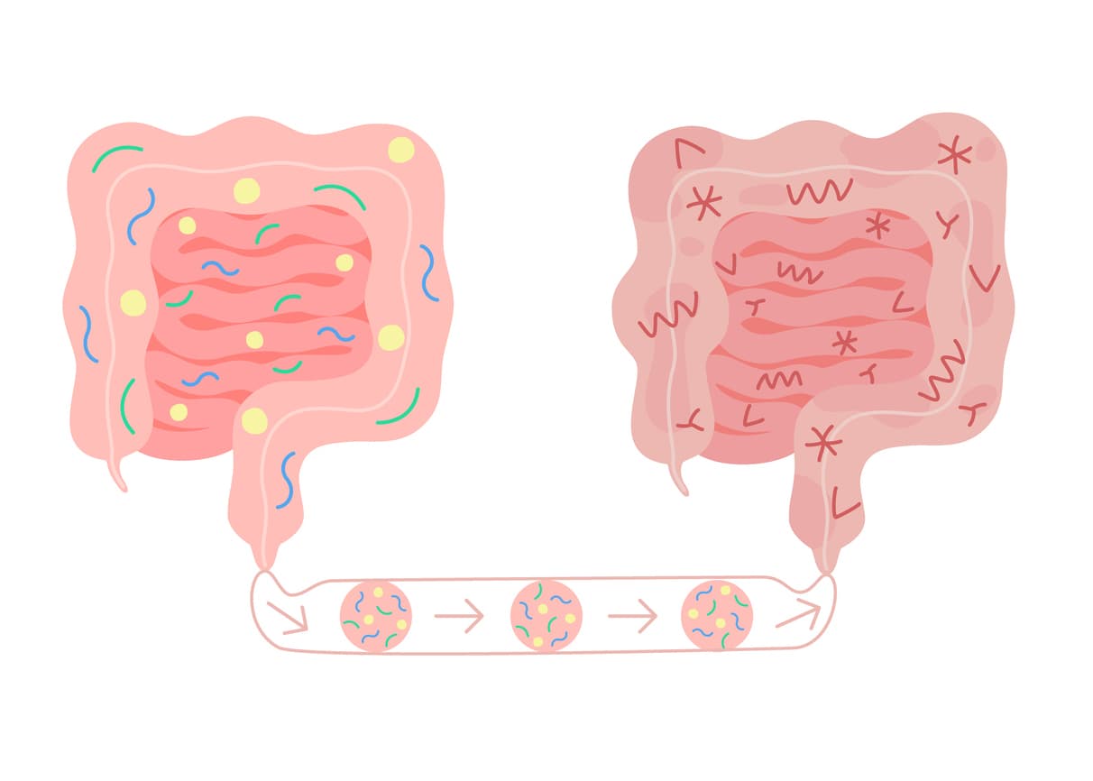 Fecal microbiota transplant from healthy in unhealthy intestine, FMT. Improvement intestinal microflora and normalization stool by introducing beneficial bacteria in bowel colon tract. Vector stock illustration