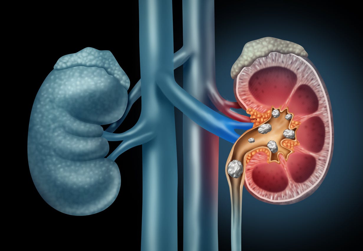 Kidney stone stock image