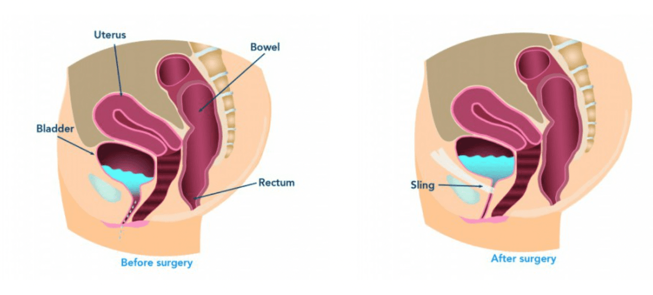 Does Medicare Cover Bladder Sling Surgery? 1 Does Medicare Cover Bladder Sling Surgery?