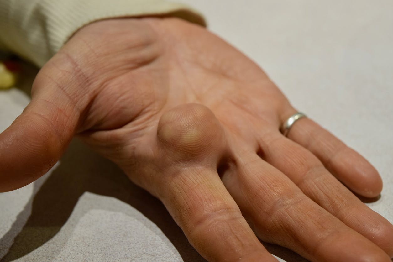 Close up top view of a woman showing a round-shaped Lipoma fatty tumor on an open palm stock photo