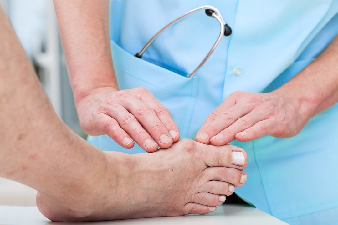 Orthopaedist at work treating a bunion, stock photo