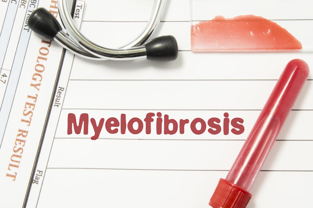 Myelofibrosis stock image