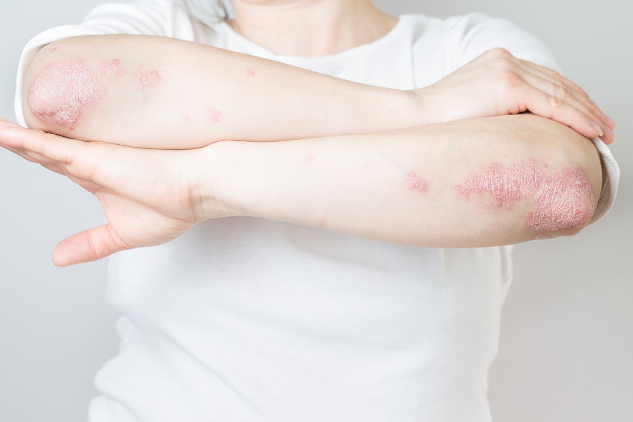 Acute psoriasis on elbows is an autoimmune incurable dermatological skin disease stock photo