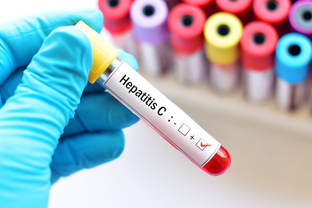 Hepatitis C stock photo
